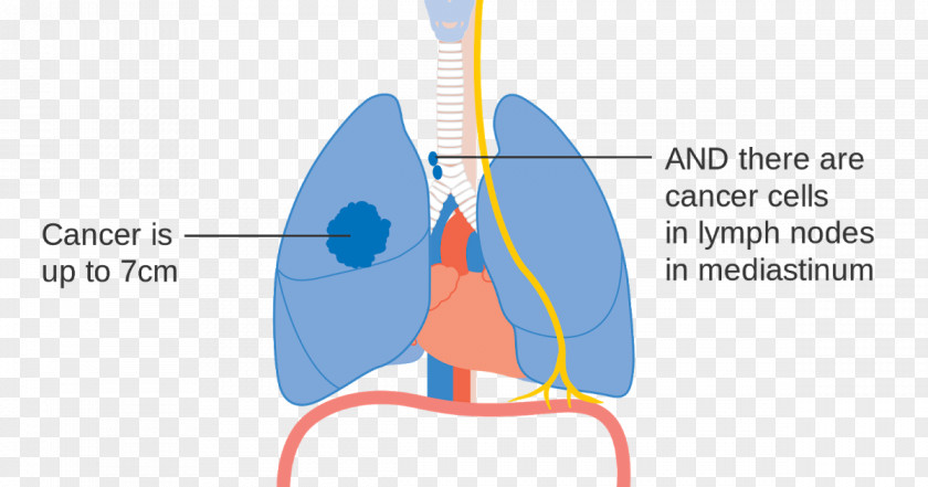 Human Lungs Lung Cancer Staging PNG