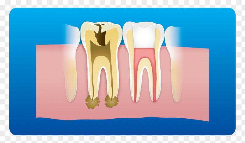 Dental Clinic Card Tooth Implant Root Canal Dentistry Pulp PNG