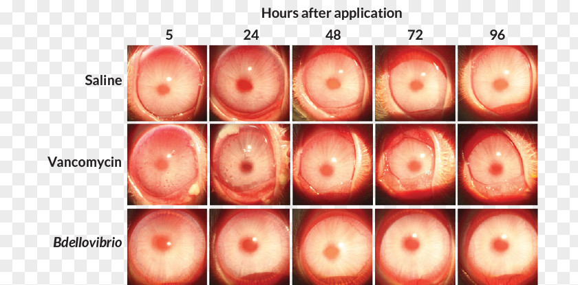 Killing Bacteria Bdellovibrio Slit Lamp Antibiotics Vancomycin PNG