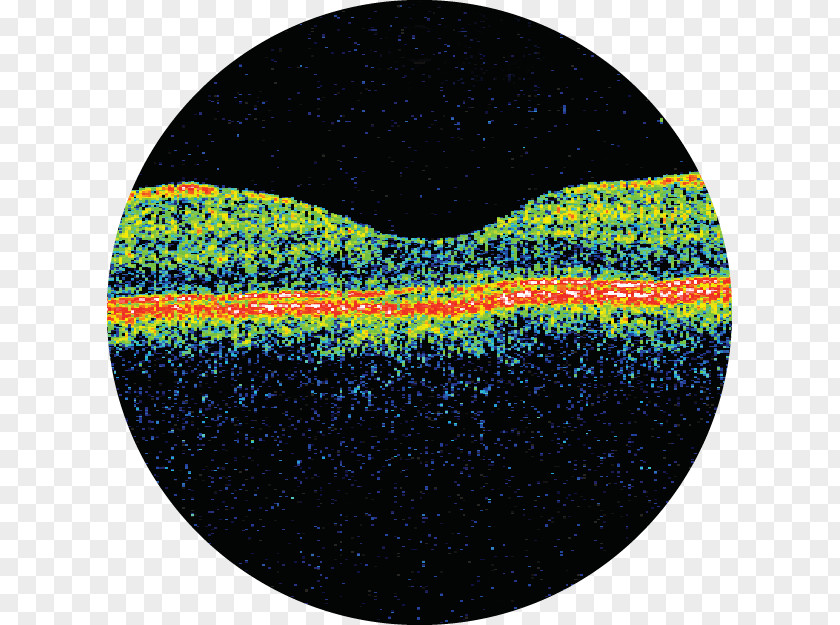 Astha Hospital Optical Coherence Tomography Critical Appraisal Medicine PNG