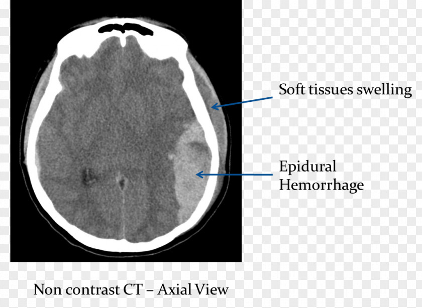Brain Computed Tomography Of The Head Epidural Hematoma Cerebral Hemorrhage PNG