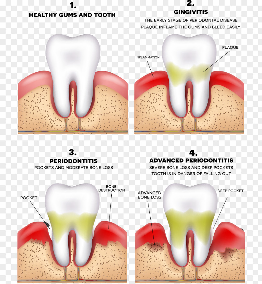 Vector Teeth And Bad Periodontitis Disease Gums Periodontology Dentistry PNG