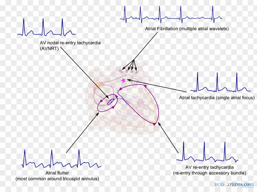 Heart Supraventricular Tachycardia Arrhythmia Atrial Fibrillation PNG