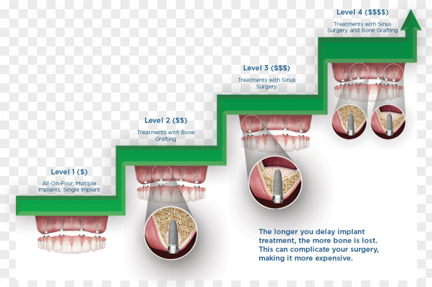 Dentistry Dental Implant Insurance Bridge PNG