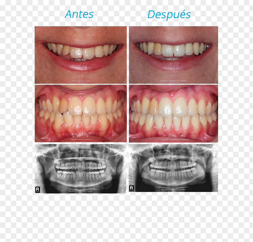 Justify Tooth Orthodontics Malocclusion Dr. Castaños Ortodoncia Incisor PNG