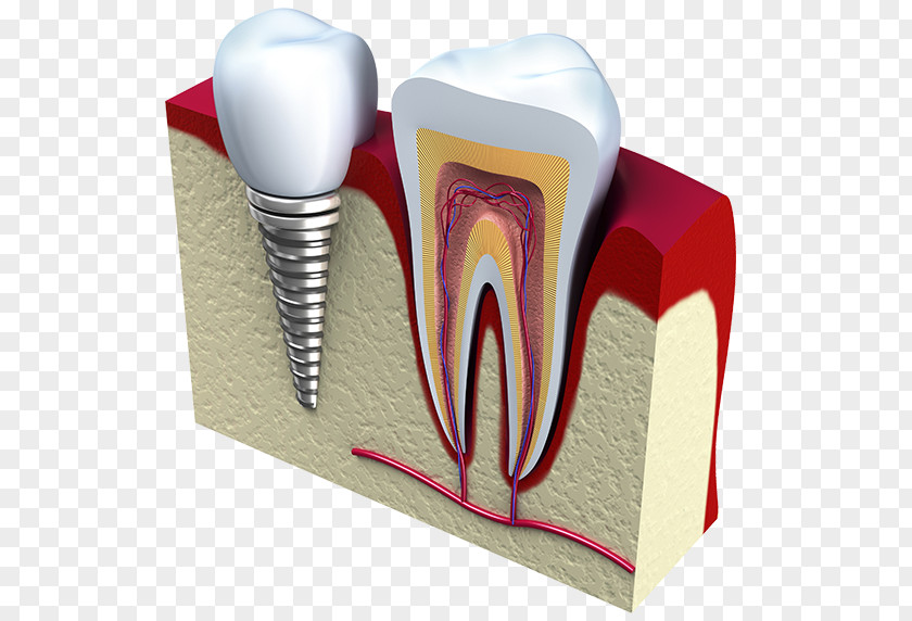 Dental Implant Dentistry Tooth Surgery PNG