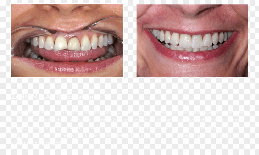 Dentures Close-up Human Tooth PNG