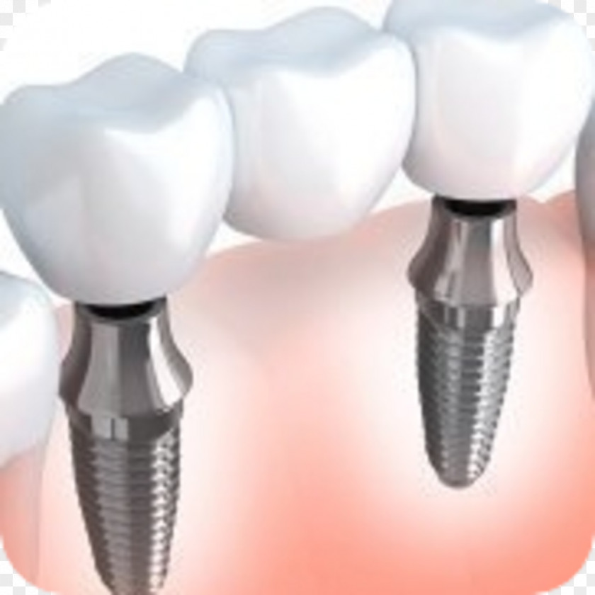 Implants Dental Implant Bridge Dentistry Dentures PNG