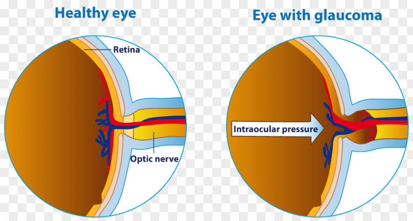 Eye Human Glaucoma Care Professional Optic Nerve PNG