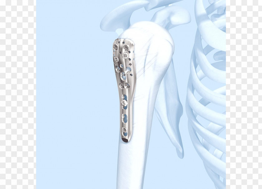 Shoulder Humerus Fracture Bone Diaphysis PNG