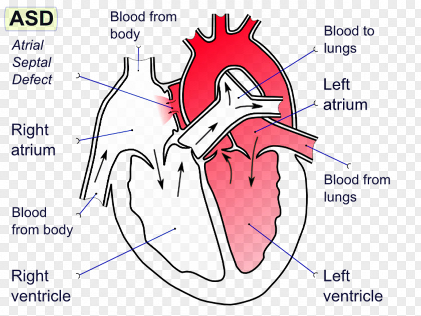 Heart Atrial Septal Defect Ventricular Atrium Interatrial Septum PNG