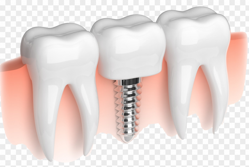 Dissolve Dental Implant Dentistry Dentures Bridge PNG