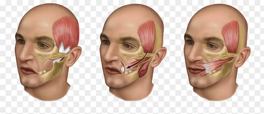 Pain Face Temporal Muscle Surgery Tendon Buccal Fat Pad PNG