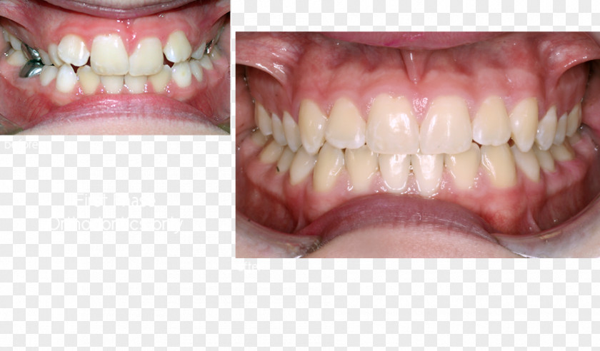 Tooth Dentures Close-up PNG