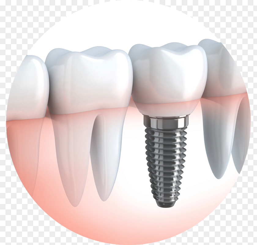 Crown Dental Implant Dentistry Chapel Gate PNG