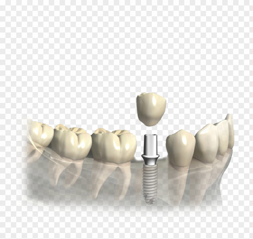 Korona Tooth Dentistry Dental Implant Prosthesis PNG