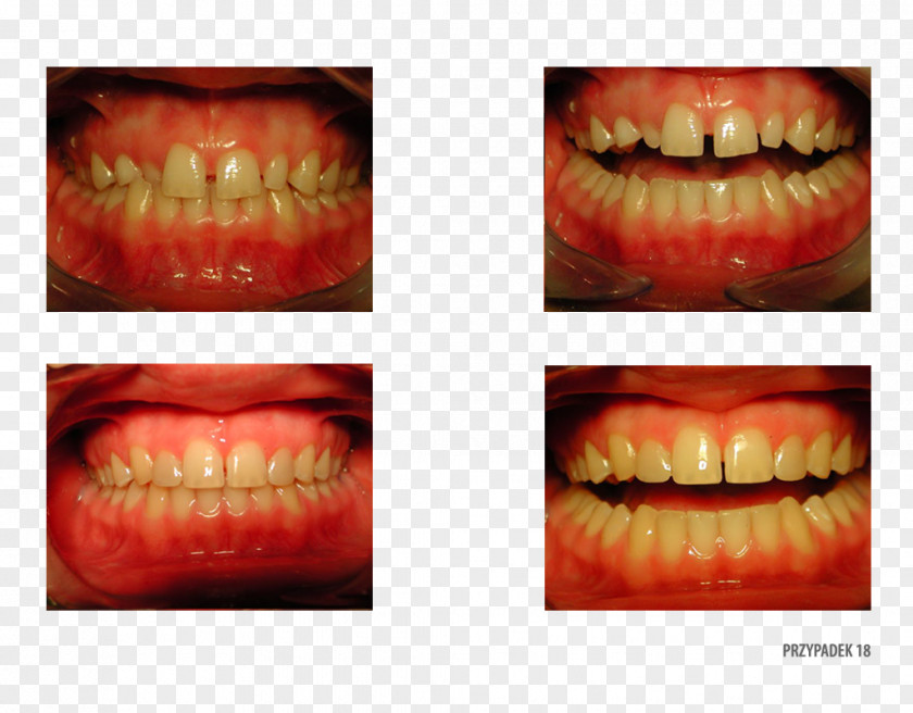 Camera Gums Gingivoplasty Ortoprotex Tooth PNG