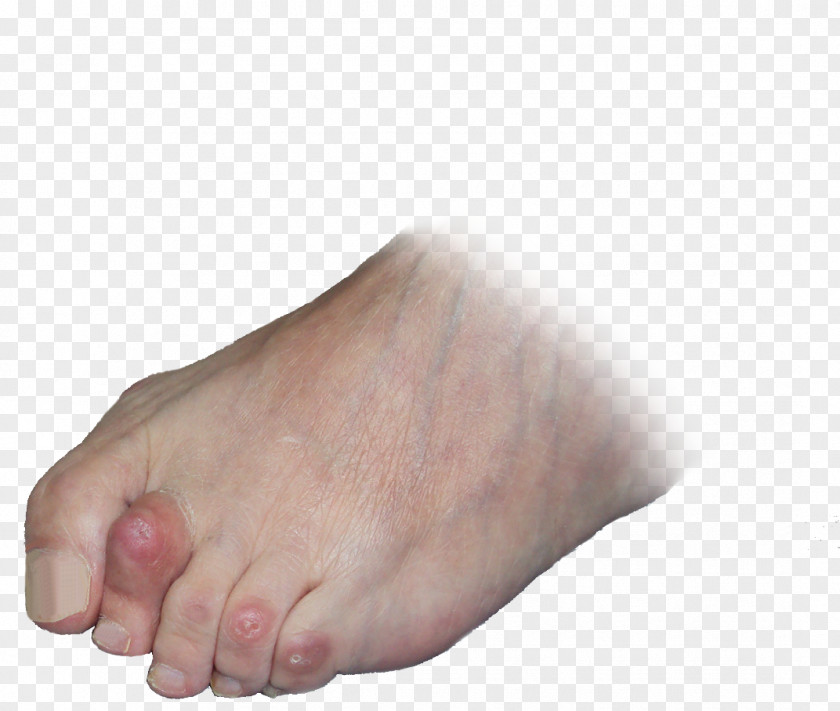 Wyroby Medyczne Refundowane Toe Digit Bent Finger Foot PNG