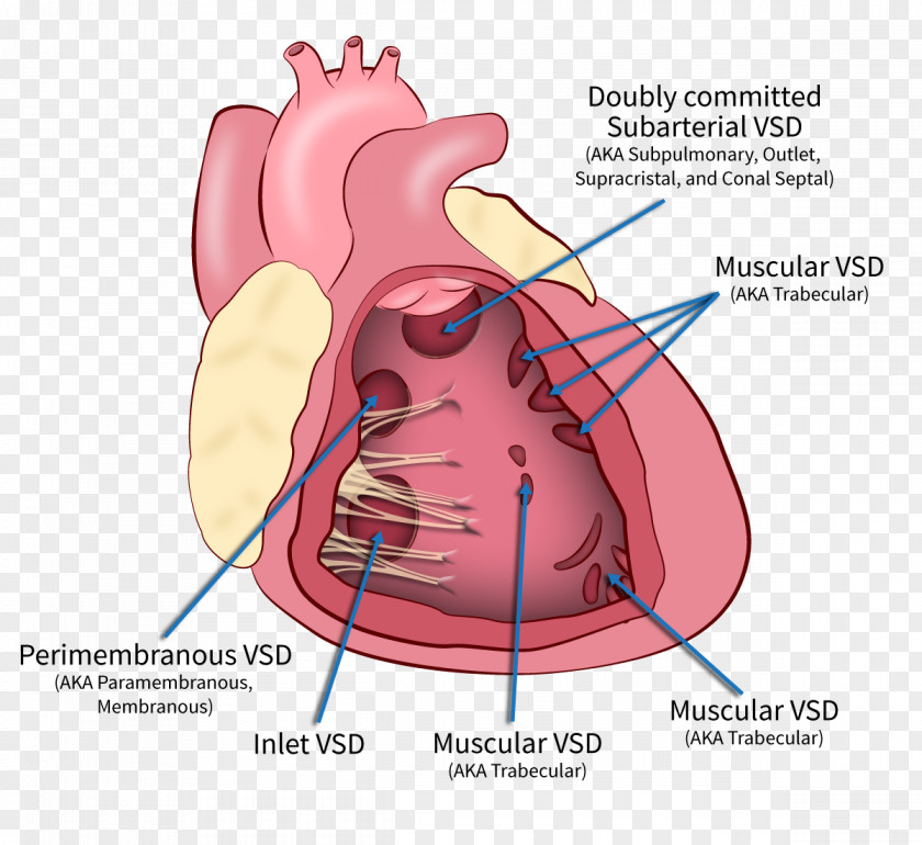 Heart Ventricular Septal Defect Interventricular Septum Ventricle PNG