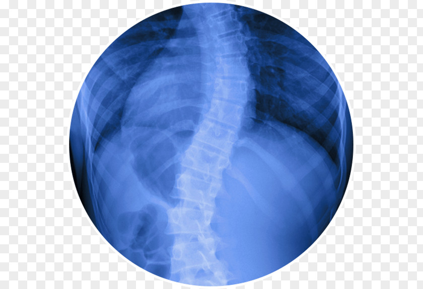 Degenerate Scoliosis Vertebral Column Surgery Therapy Back Pain PNG