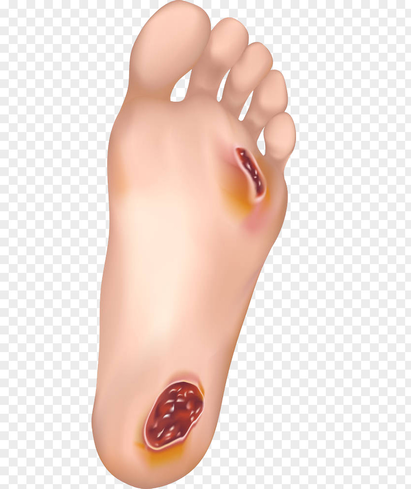 The Dangers Of High Blood Sugar Diabetic Foot Ulcer Wound Healing Skin PNG