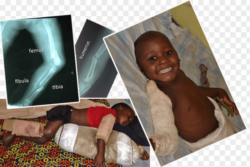 Child Tibia Bone Fracture Femur PNG