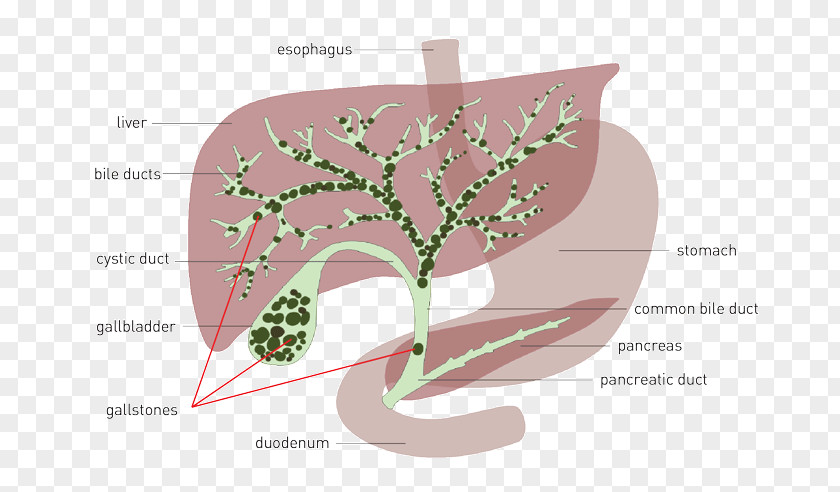 Activities Will Be Reduced At Full Time Liver And Gallbladder Gallstone Bile Flush PNG