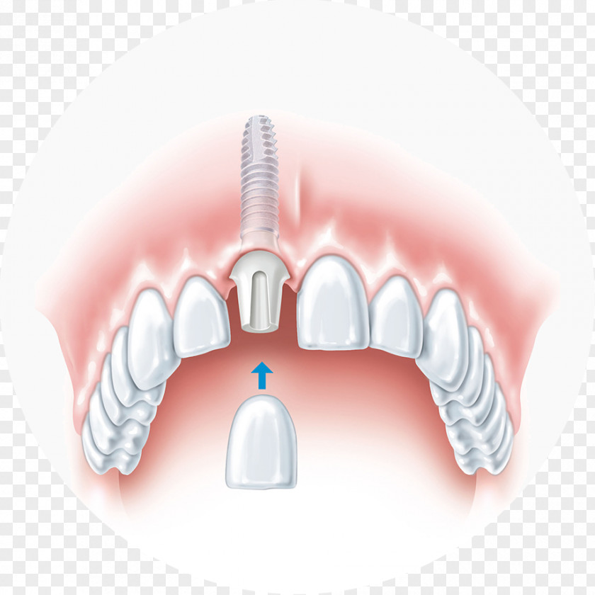 Bridge Dental Implant Dentistry PNG