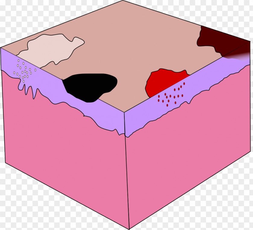 Aloe Maculata Macule Dermatology Skin Cavernous Hemangioma Wykwit PNG