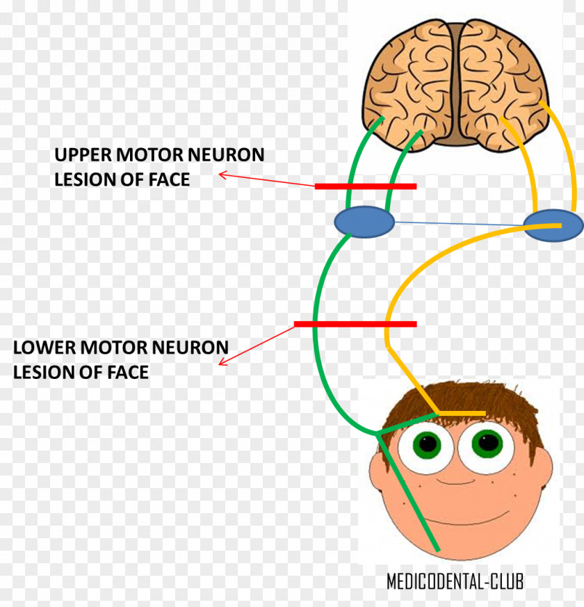 Cranial Nerve Lower Motor Neuron Lesion Facial Upper PNG