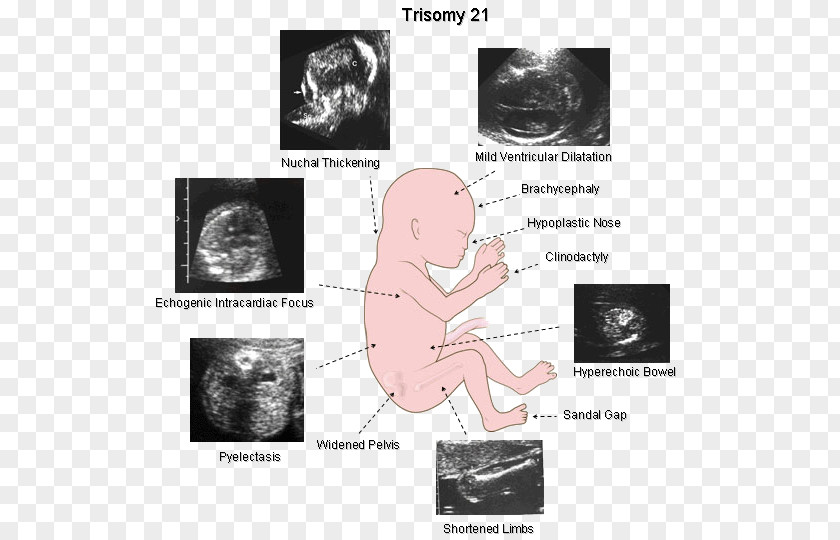 Down Syndrome Ultrasonography Sonographer Fetus PNG