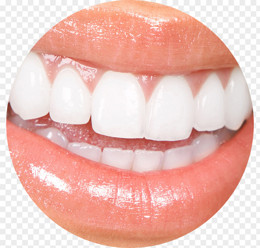 Tooth Surgery Veneer Cosmetic Dentistry Whitening PNG