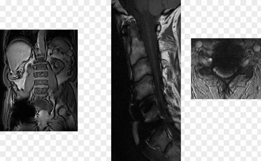 Mrt Radiology Magnetic Resonance Imaging Halswirbelsäule Anatomy Gadolinium PNG