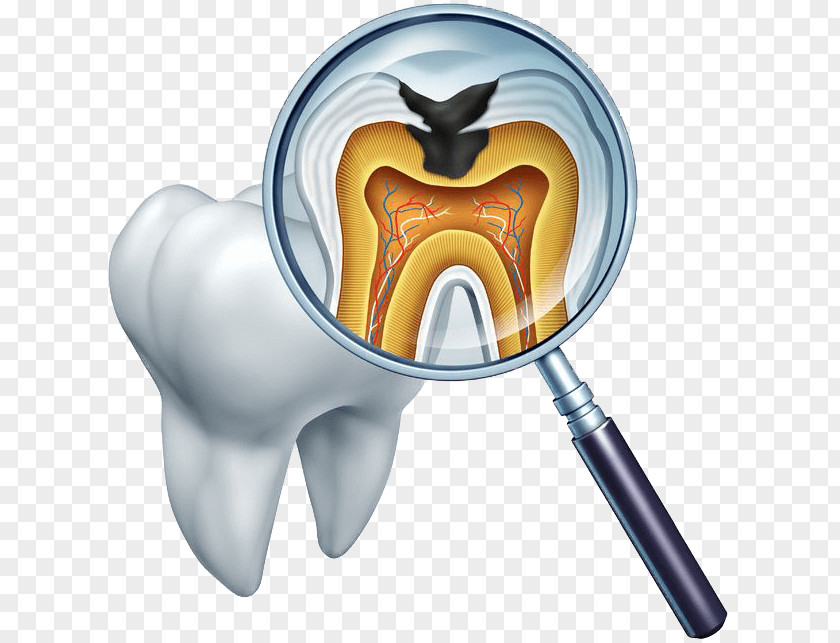Tooth Decay Dentistry Therapy PNG