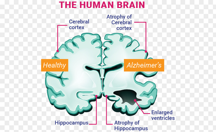 Brain Alzheimer's Disease Amyloid Beta PNG
