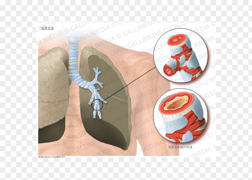 Bronchial Acute Bronchitis Asthma Lung Bronchiolitis Bronchus PNG