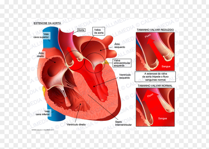 Heart Mitral Valve Stenosis Insufficiency Aorta Aortic PNG