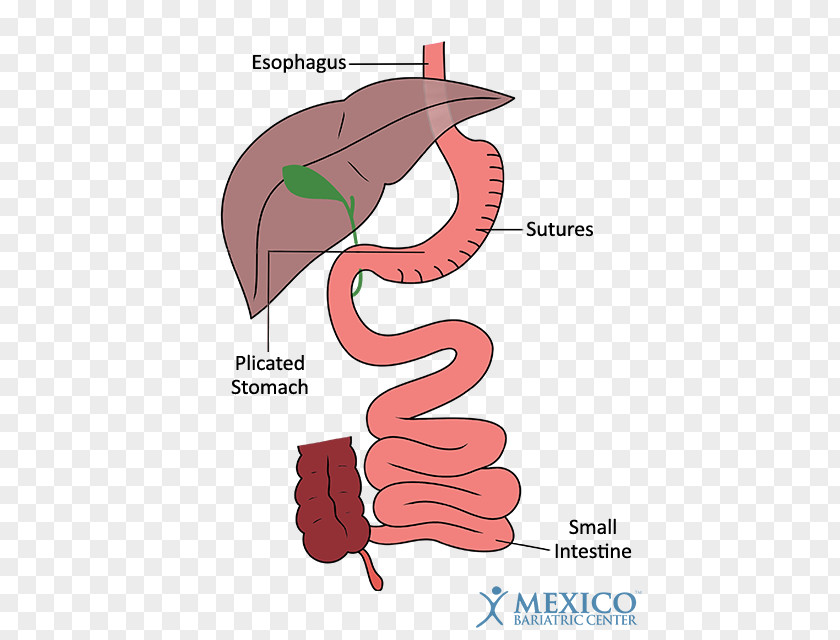 Duodenal Switch Operation Bariatric Surgery Sleeve Gastrectomy Gastric Bypass PNG