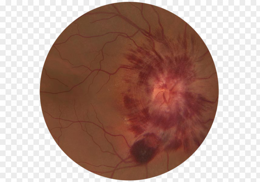 Eye Virtual Patient Ophthalmoscopy Retina PNG