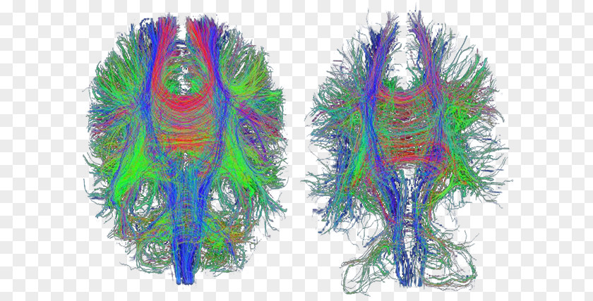 Brain Traumatic Injury Diffusion MRI Alzheimer's Disease Medical Imaging PNG