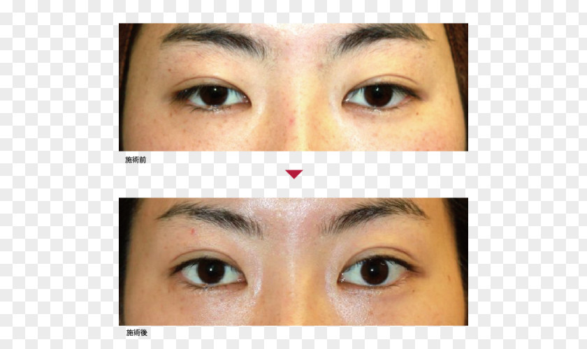 Eye Case Eyebrow Eyelid Eyelash Extensions Primo Azabujuban Clinic PNG