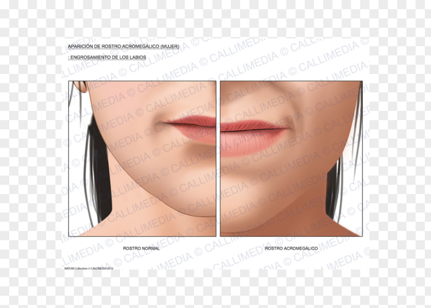 Nose Acromegaly Lip Face Diabetes Mellitus PNG