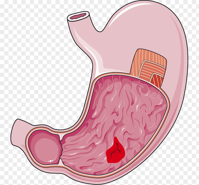 Stomach Peptic Ulcer Disease Digestion Small Intestine PNG ulcer disease intestine , others clipart PNG