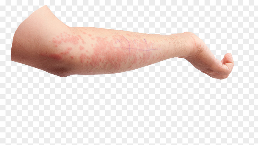 Hand Skin Allergy Psoriasis Symptom Dermatology Thumb PNG