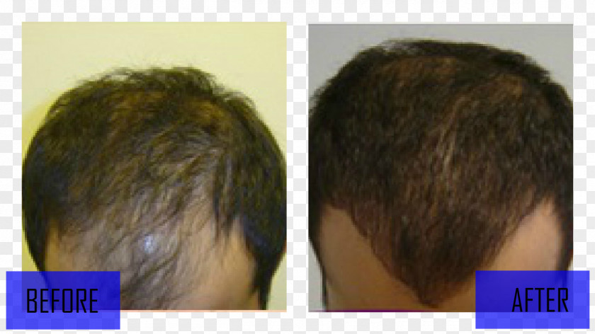 Hair Transplantation Loss Wig Black PNG