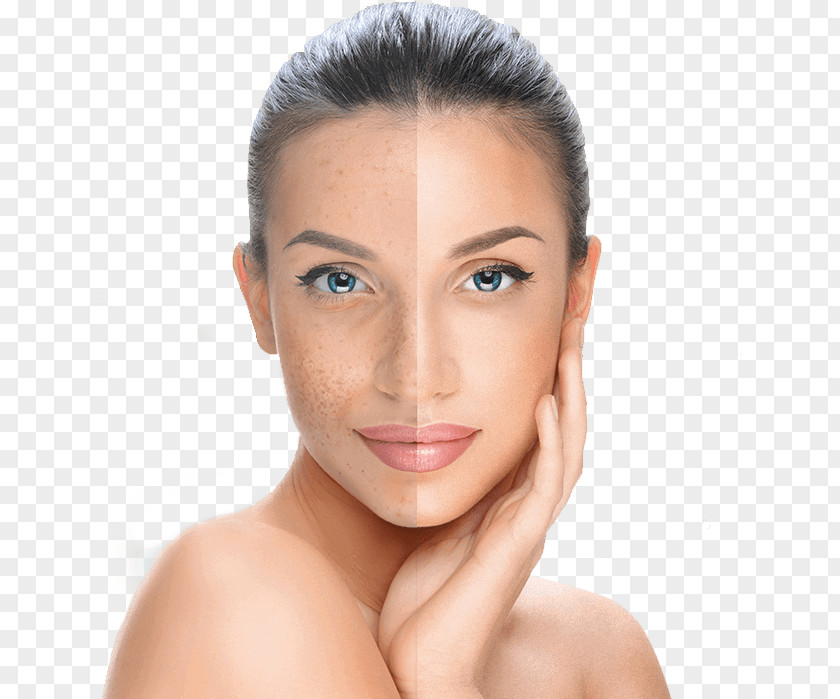Mulberry Chemical Peel Facial Skin Exfoliation Surgery PNG