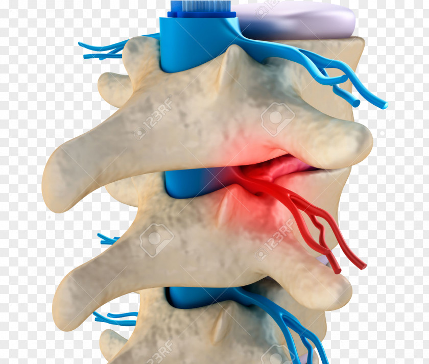 Vertebral Column Subluxation Spinal Disc Herniation Cervical Vertebrae PNG