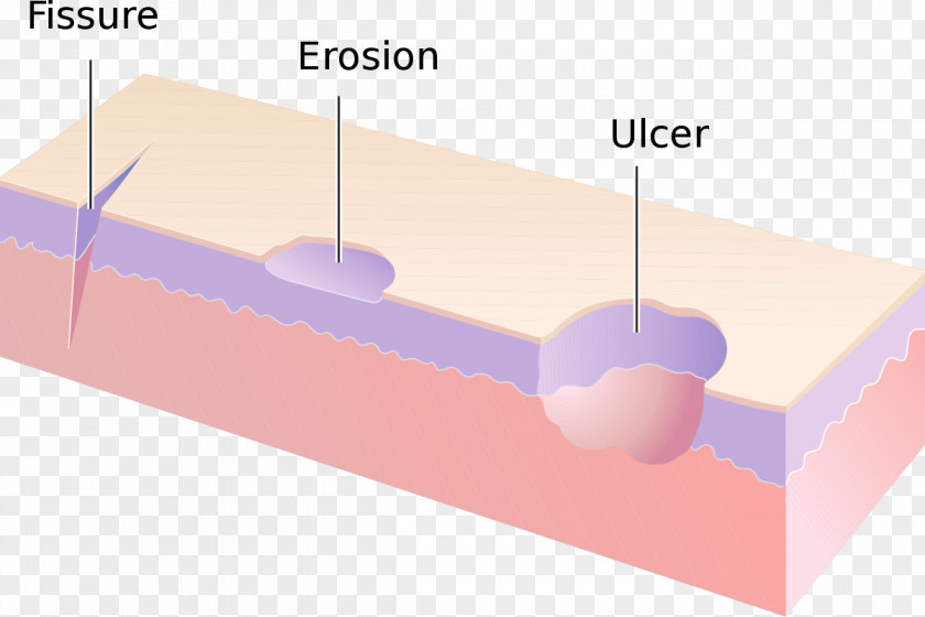 Fissure Erosion Dermatology Cutaneous Condition Skin Ulcer PNG