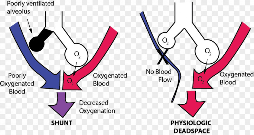 Dead Space Pulmonary Shunt Ventilation/perfusion Ratio PNG