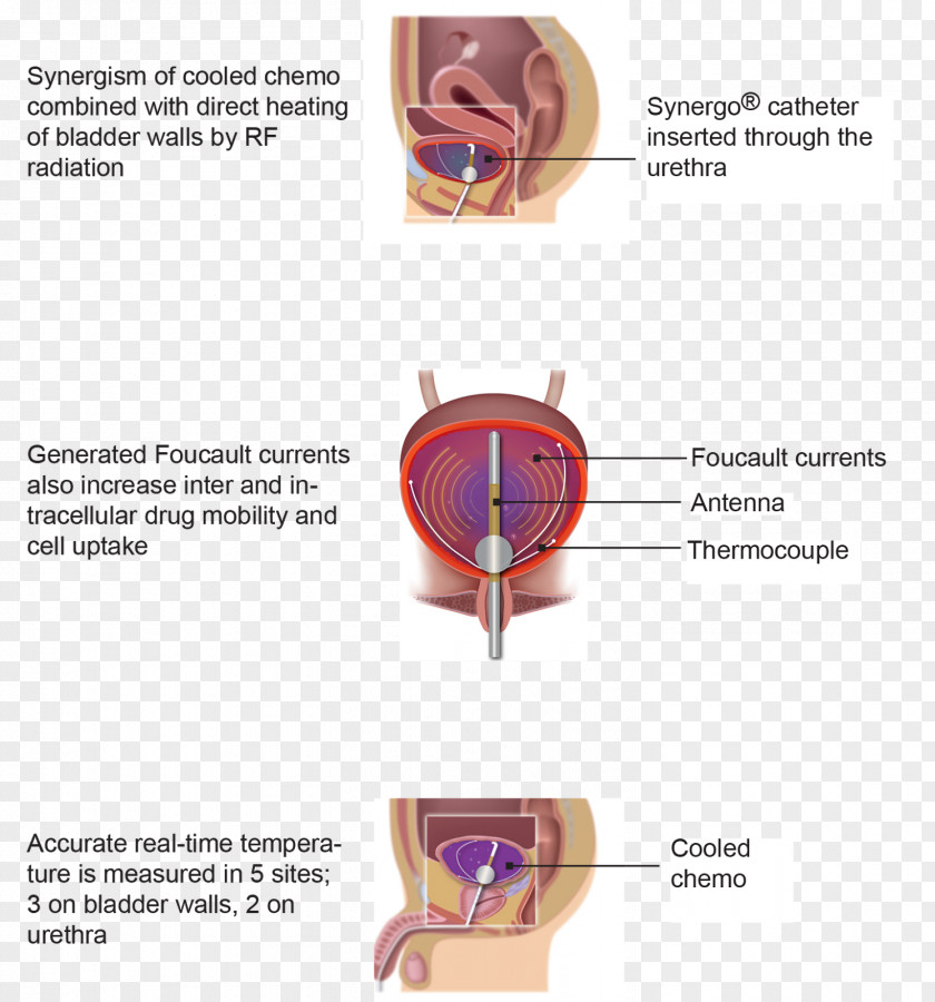 Therapy Bladder Cancer Mitomycin C Patient Disease PNG